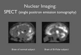 SPECT Single Photon Emission Computer Tomography Tomografia Computerizzata ad emissione di singolo fotone La SPECT (Single Photon Emission Computed Tomography) è una tecnica tomografica in cui