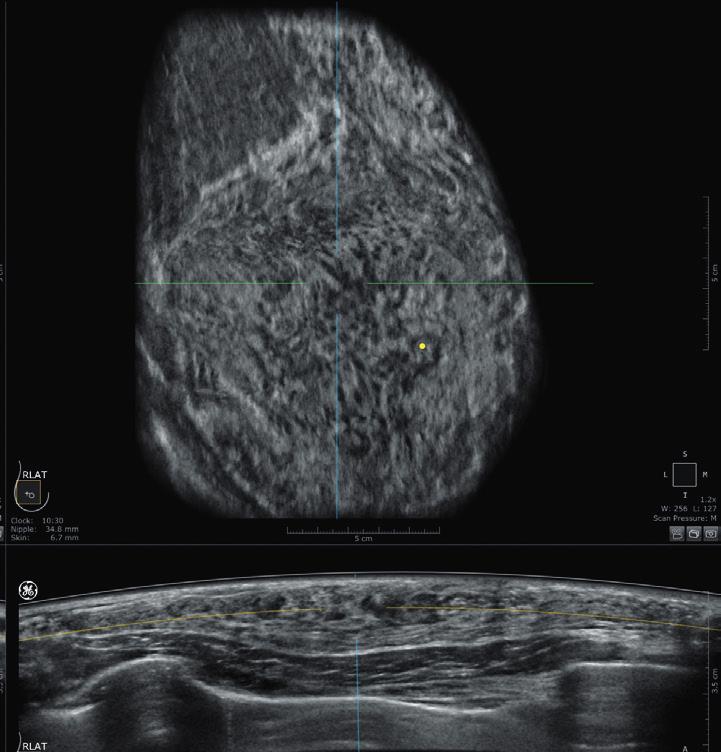 Rilevazione avanzata. Invenia ABUS contribuisce a rilevare un maggior numero di lesioni tumorali. 4 Diagnosi avanzata.