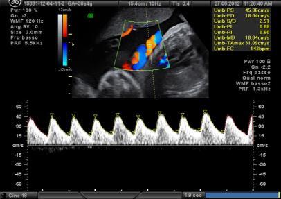 percentile EFW < 10 percentile con PI AO > 95 percentile CPR < 5 centile Media PI UtA > 95 percentile Peso neonatale < 3