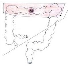 colon-rettale 45.75.