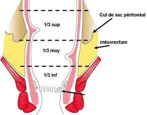 Figura sinistra (incluso il sigma) e anastomosi colon-rettale a livello della parte alta del retto Piani anatomici della congiunzione colon-rettale