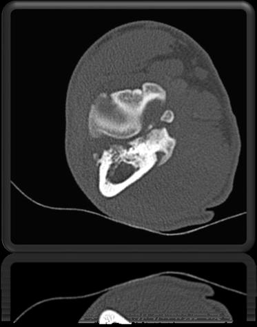 traumatica Neoplasie