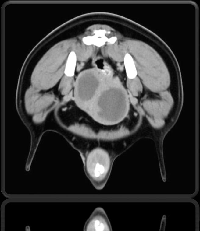 Scavo pelvico Addome Prostata Uretra