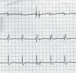 GIAC Volume 5 Numero 4 Dicembre 2002 La cardiostimolazione è da tempo una terapia affermata nella pratica clinica 1,2 e probabilmente in ulteriore espansione alla luce delle nuove indicazioni per il