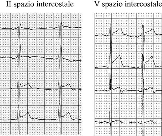 B: spostando gli elettrodi V1-V4 nel secondo spazio intercostale le turbe del tratto ST si riducono, mentre persistono se si spostano gli elettrodi nel quinto spazio intercostale.