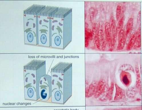 Ad un esame istologico (in tessuti colorati con EE) l apoptosi coinvolge singole cellule o piccoli aggregati cellulari.