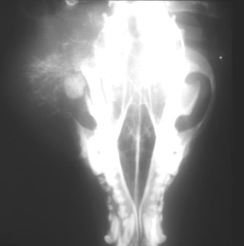 Osteosarcoma: