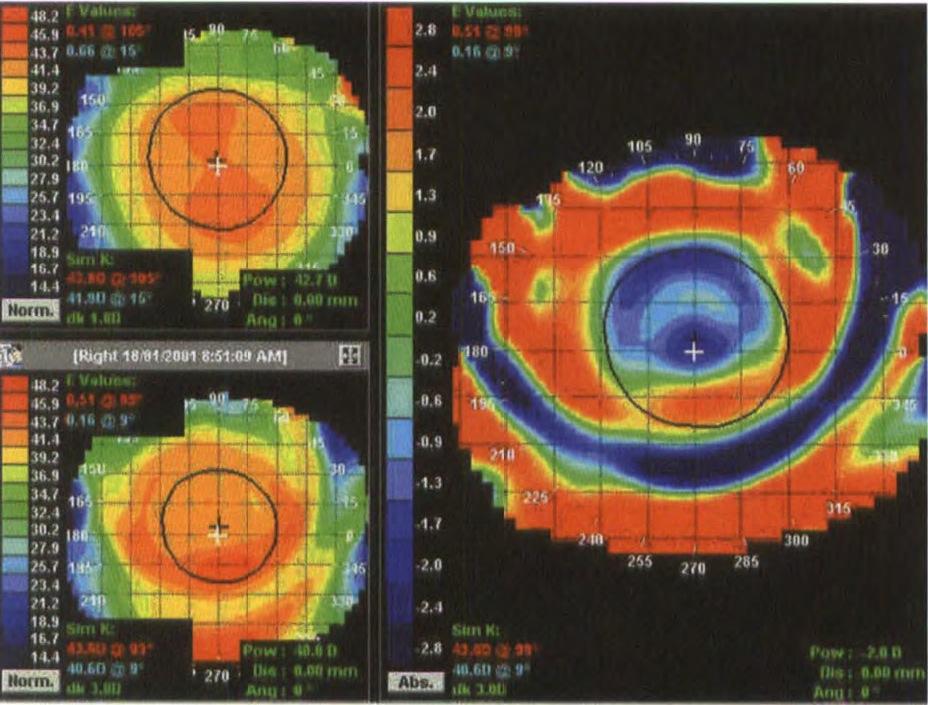 da effettuare, durante le visite di controllo, è la posizione della lente sulla cornea affinchè la zona di appiattimento non si decentri dalla pupilla.