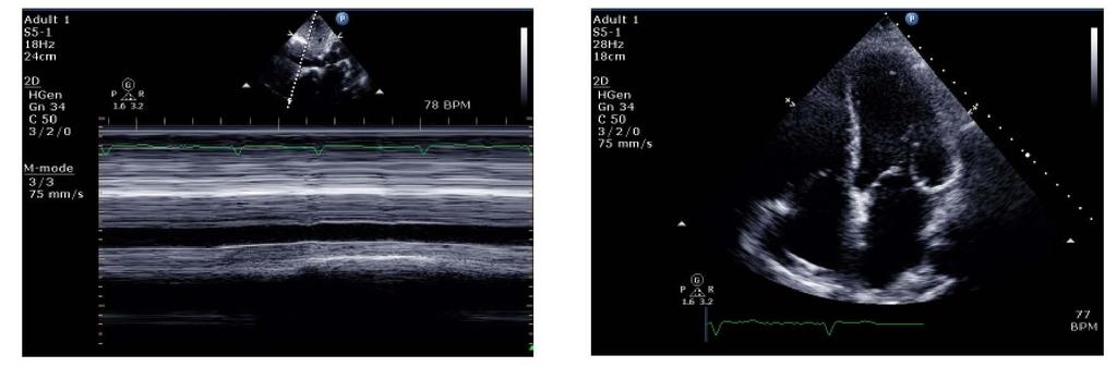 ..al controllo ecocardiografico (effettuato durante FA a 120 bpm) Camere di sinistra dilatate; FE: 35%, ipocinesia globale VCI dilatata, scarsamente