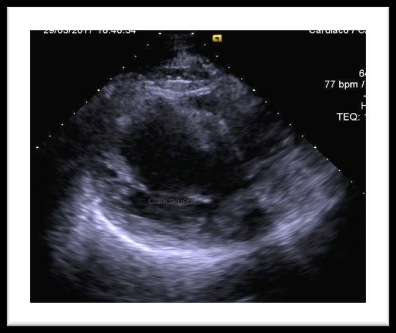 Ecocardiogramma: ventricolo sinistro di