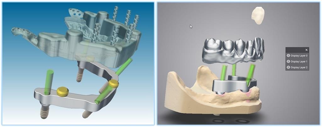 Wax-up Virtual Wax-up senza mncni: Il wax-up senza mncni è liber da un legame al margine.