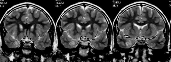 Cortical Dysplasias : a