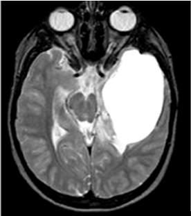 gliali neoplastiche Nella maggior parte