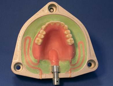 La protesi polimerizzata subito dopo l apertura della muffola. La resina del corpo protesico aderisce molto bene al dente.