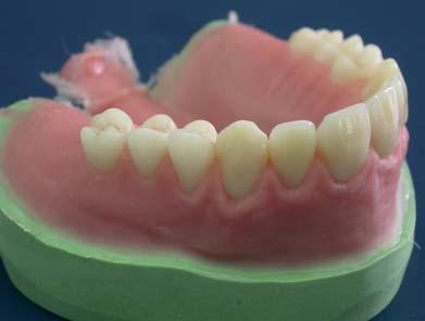 Non si rende pertanto necessaria la rifinitura vicino al dente, non pregiudicando così il lungo lavoro eseguito durante la modellazione in cera.