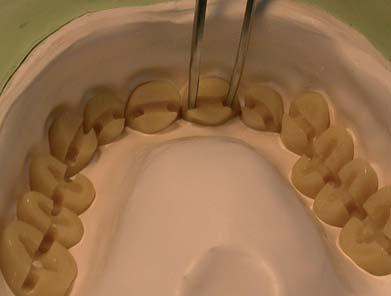 I denti di resina, irruviditi e muniti di ritenzioni, vanno riposizionati nel controstampo.