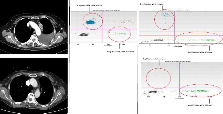 Paziente con ADK EGFR L858R + con T790M, in risposta