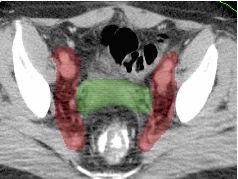 Tumore della cervice e dell endometrio Radioterapia ad intensità modulata Definizione CTV Post-operatorio Iliaci comuni Iliaci esterni Iliaci interni Otturatori Para-aortici Pre-sacrali [S1-S2] Se