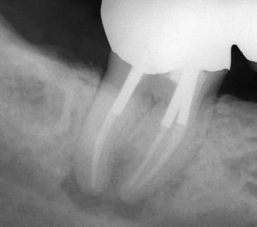 Lo scarso adattamento marginale della corona protesica, il sospetto di una probabile infiltrazione coronale, l otturazione sottoestesa dei canali radicolari nonché il sospetto di una anatomia