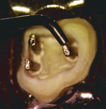 L Informatore Endodontico Vol.2, Nr.2 1998 tunamente sondato e preparato (Fig.12).