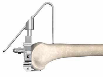 Scorpio NRG Sistema protesico a raggio singolo di ginocchio primario a riferimento posteriore Protocollo chirurgico del femore Resezione anteriore regolata troppo sporgente 2 mm Resezione anteriore