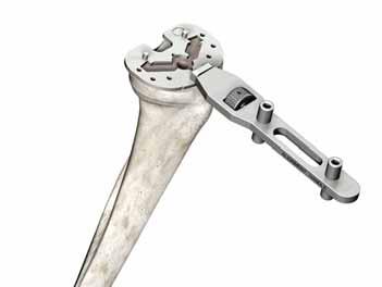 Scorpio NRG Sistema protesico a raggio singolo di ginocchio primario a riferimento posteriore Protocollo chirurgico della base Misurazione del componente Scorpio NRG > Flettere completamente il