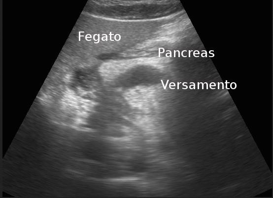 questo senso come alternativa alla Tomografia assiale Computerizzata (TC) con mezzo di contrasto (m.d.c.) nei pazienti con pancreatite acuta lieve.