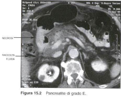 Fig.5 E raccomandato infine eseguire una TC in tutti i pazienti con insufficienza d organo, dolore addominale persistente e segni di sepsi.