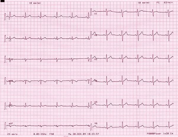 ECG o ECG