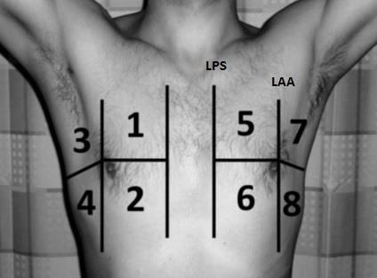 MATERIALI E METODI N=124 (58 M, 66 F) Età media: 81,04 ± 9,47 anni Arruola< 124 pazien4 con dispnea acuta ricovera< presso un reparto di medicina interna dell I.R.C.S.