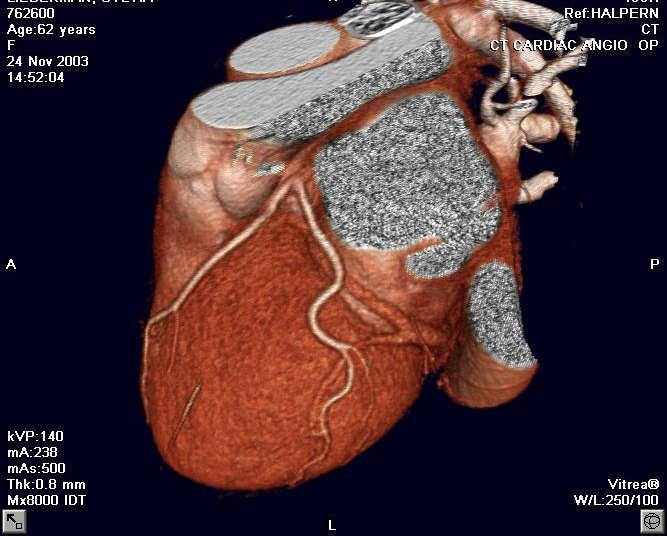 Clinical Application of MDCCT A - Coronary assessment: grading of stenosis,