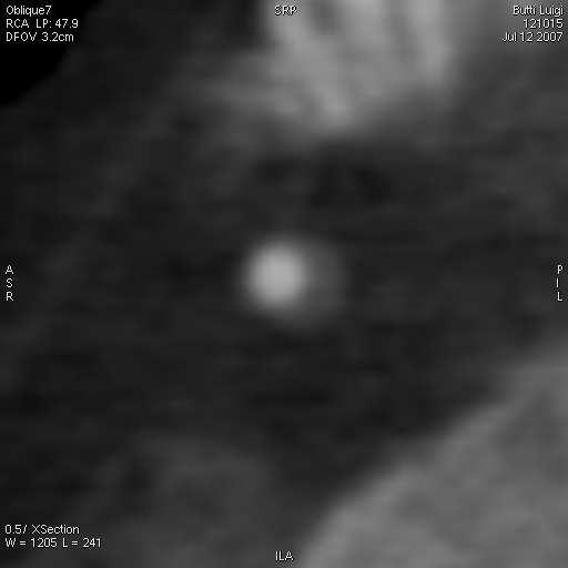 A. Coronary Assessment (12) Coronary wall