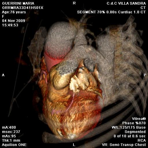 !) in hypertensive patient (Euro-Score >5%) (