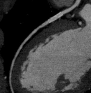 A. Coronary Assessment (16) Stent