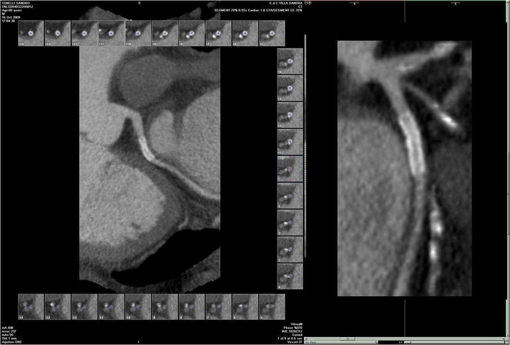 A. Coronary Assessment (18) Stent evaluation