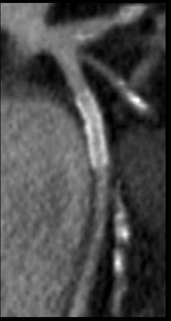 !) in hypertensive-diabetic patient (Euro-Score >5%) (