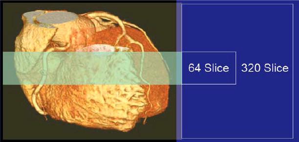 Technological advancements (1) 64-slice MDCCT: 4 cm 320-slice