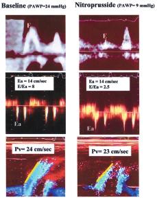 Ital Heart J Suppl Vol 1 Ottobre 2000 curatezza pressioni di riempimento ventricolare sinistro > 15 mmhg (Fig. 5).