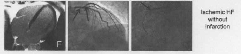 Limiti della CVG (3) O La CVG non ci informa sullo «stato di salute» del miocardio e sul