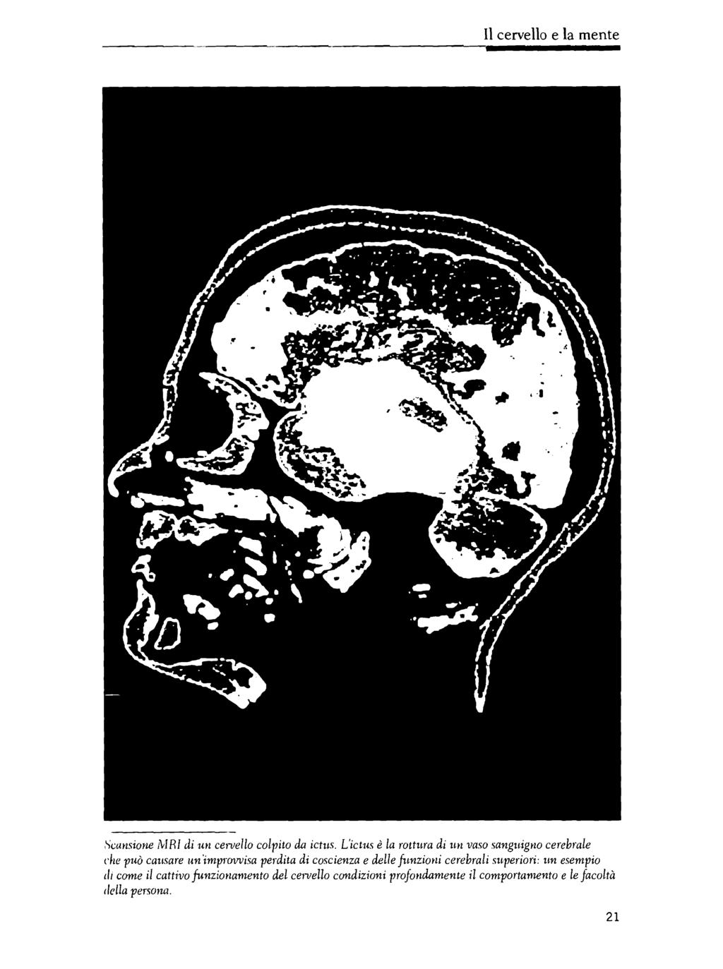 Il cervello e la mente,')i;ansione 1\IRI di un cen1ello colpito da ictus.