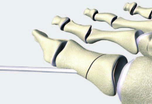 Tecnica chirurgica per placca a 2 fori Fissazione di una osteotomia di Akin Il piano preoperatorio non è descritto. 1 Osteotomia Viene praticata un incisione mediale. Eseguire l osteotomia.