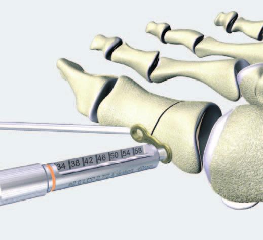 2 Fissaggio della placca Strumenti necessari Centrapunte LCP 2.7 (testa LCP 2.4), con scala fino a 60 mm 323.061 Punta elicoidale da 2.0 mm, con contrassegno doppio, lunghezza 140/115 mm 323.