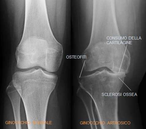 Artrite Radiograficamente è caratterizzata da un restringimento dello spazio articolare, osteofitosi, cisti subcondrali e sclerosi subcondrale.