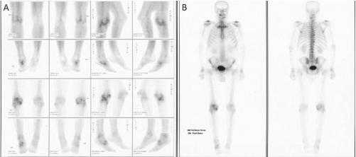 scintigrafia ossea trifasica Artrite paziente di sesso maschile di 52 anni: esame eseguito sulla base di segni radiografici di osteartrite del ginocchio.