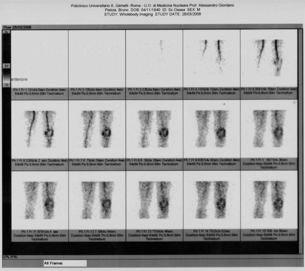 scintigrafia ossea trifasica artroprotesi ginocchio sinistro impiantata da un anno: VES 2 ; PCR 0,7; G.B. 8.