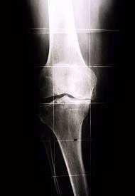 Osteomalacia Osteoartriti Osteoartrosi Artrite reumatoide