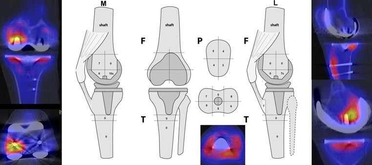 Fig. Applicazione dello schema di localizzazione in paziente con progressione dell'artrosi femoro-rotulea dopo