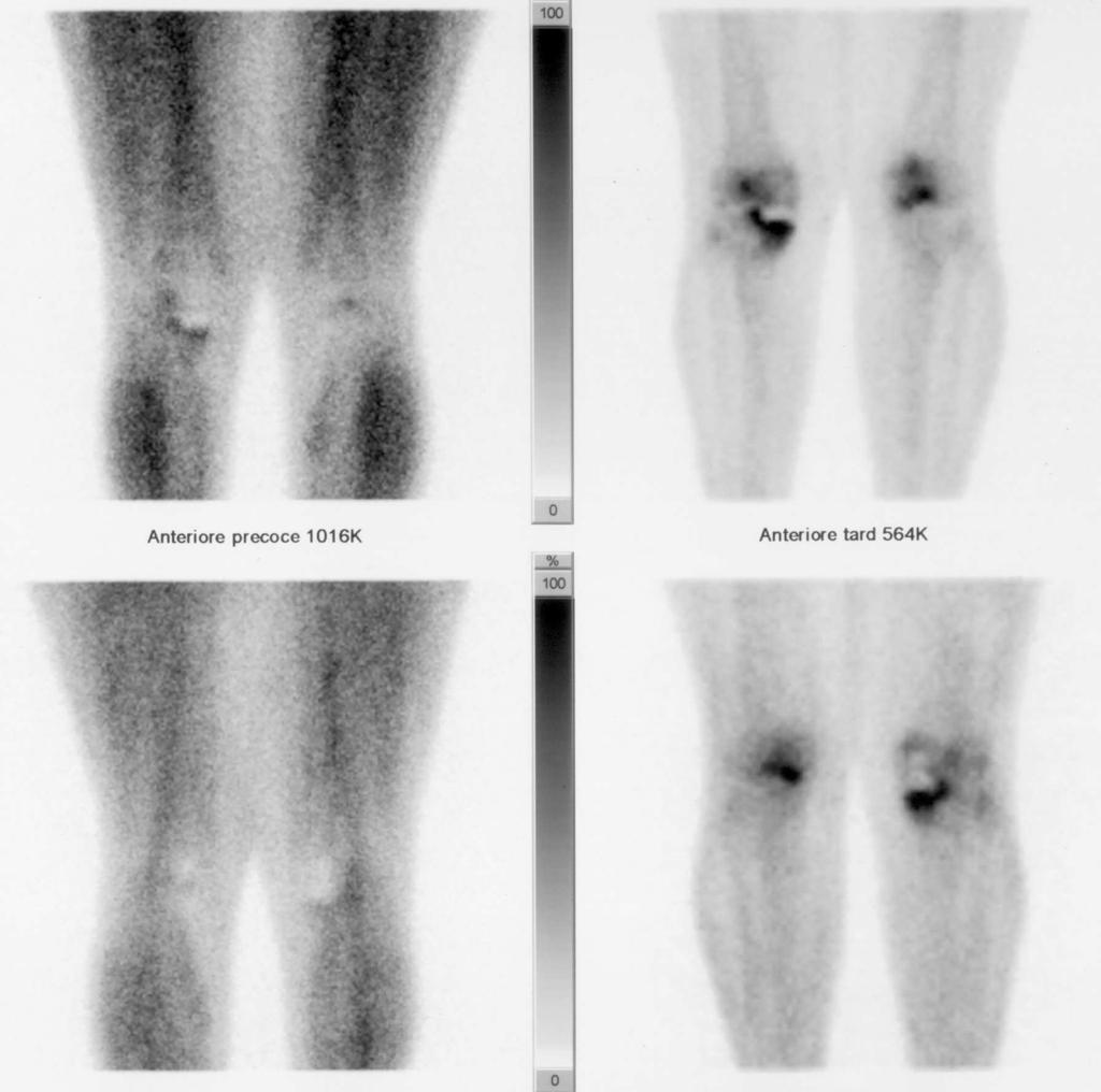 scintigrafia ossea trifasica paziente diabetico con artroprotesi