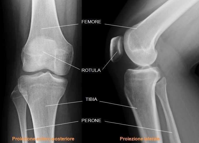 ossa: femore, rotula, tibia, perone differenti strutture anatomiche tessuti molli: cartilagine, menischi e