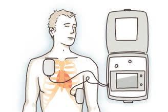 eps Posizionamento nell asse cardiaco: sul fianco sinistro e sotto la clavicola destra Durante l installazione dello strumento proseguire le